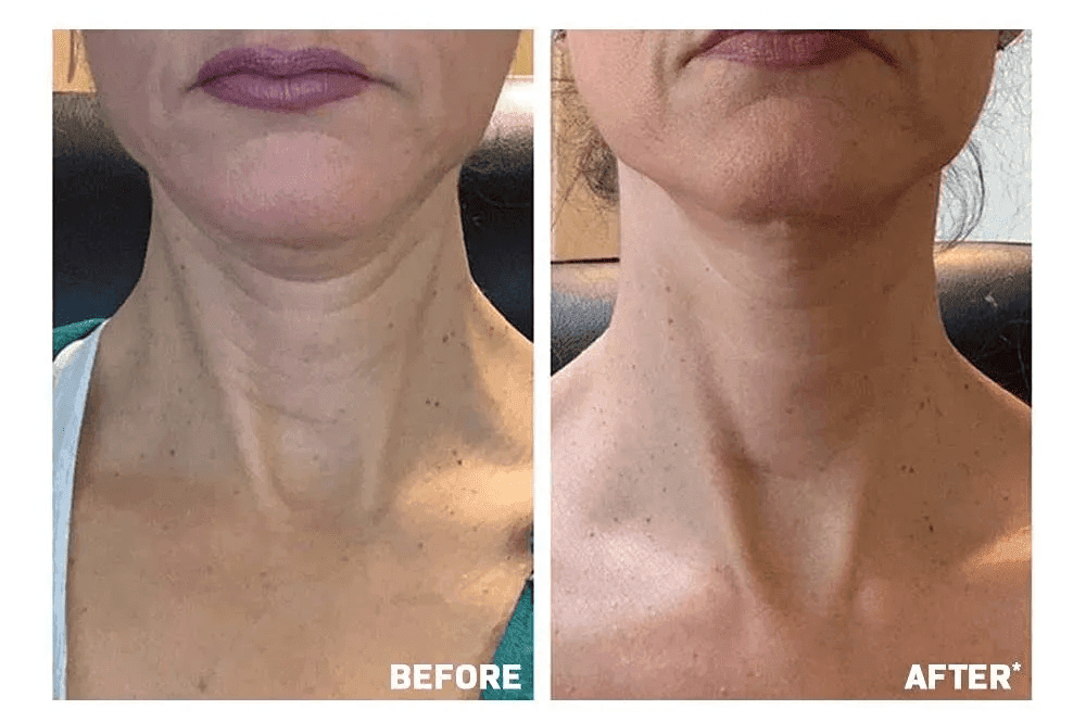 Turkey Neck Cream Effects