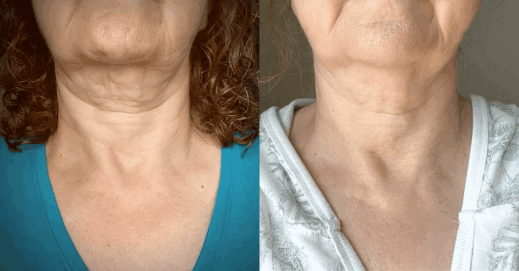 Best Neck Cream For Turkey Neck